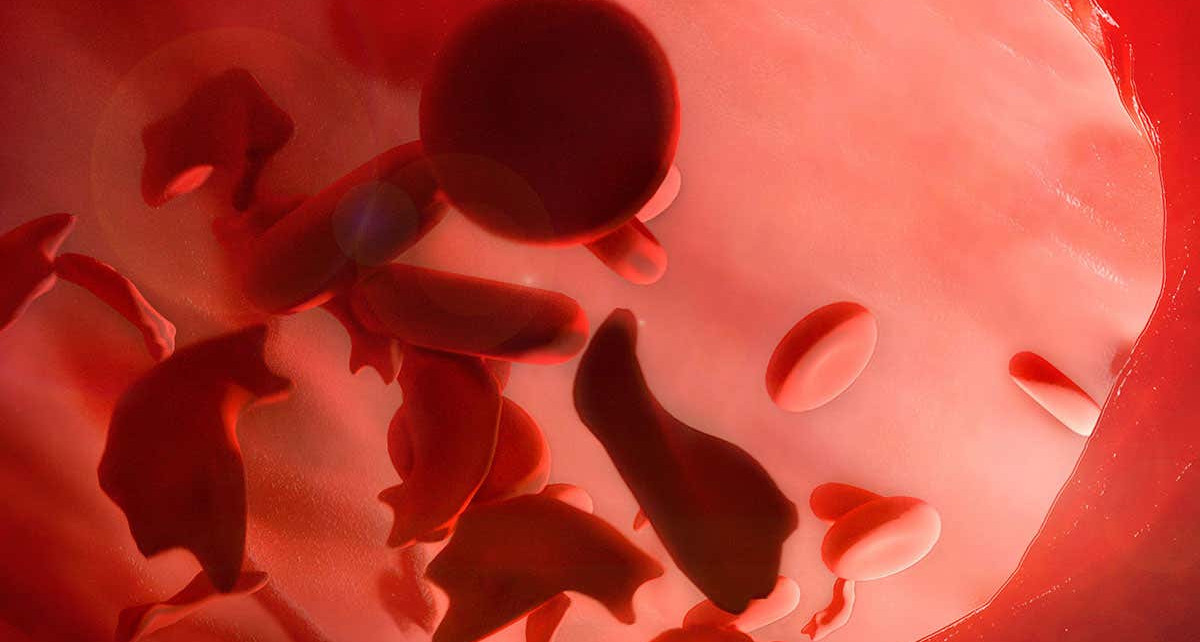 AI helps assess pain levels in people with sickle cell disease
