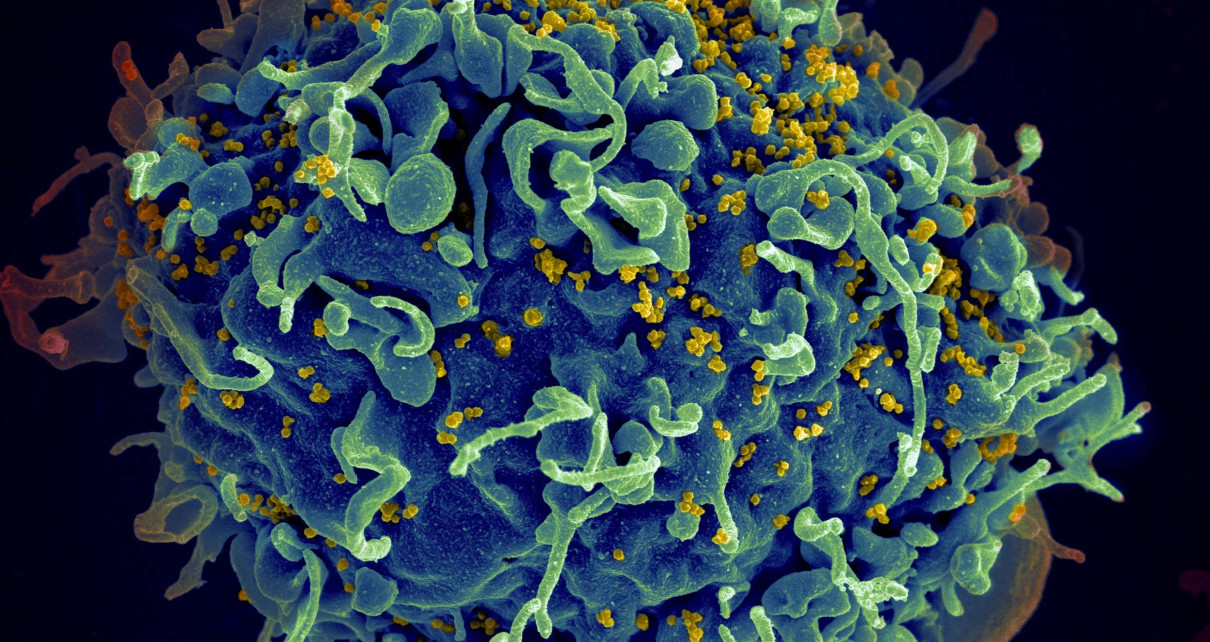 ECF1N3 Scanning electron micrograph of HIV particles infecting a human H9 T cell.