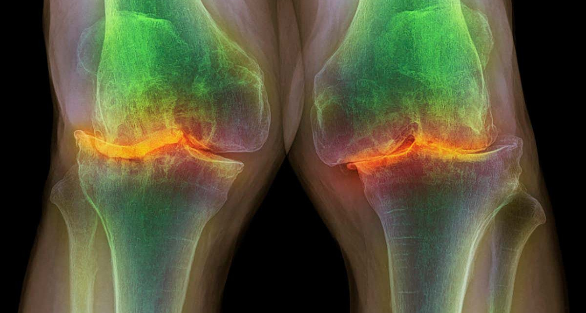 Osteoarthritis: Lubricating arthritic knees may help them heal