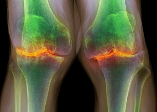 Osteoarthritis: Lubricating arthritic knees may help them heal