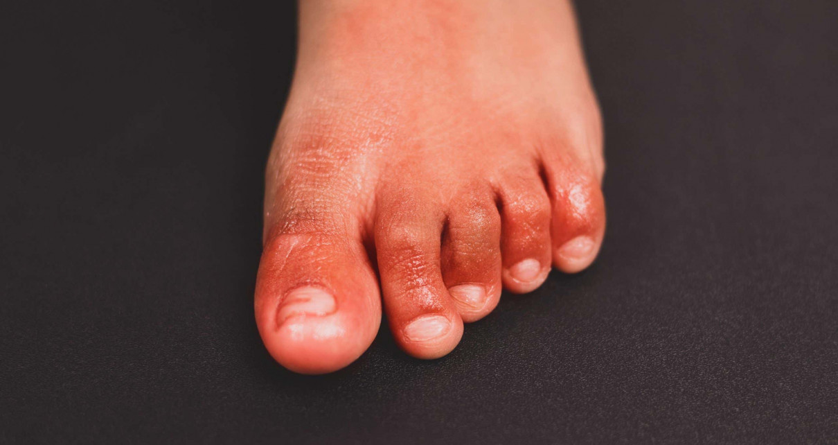 Covid-19 news: ‘Covid toe’ may be side effect of immune response