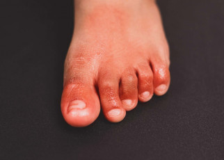 Covid-19 news: ‘Covid toe’ may be side effect of immune response