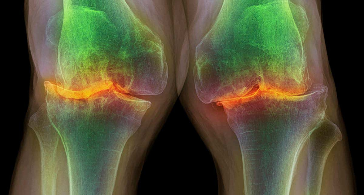 Osteoarthritis: Electric knee implants could help repair worn cartilage