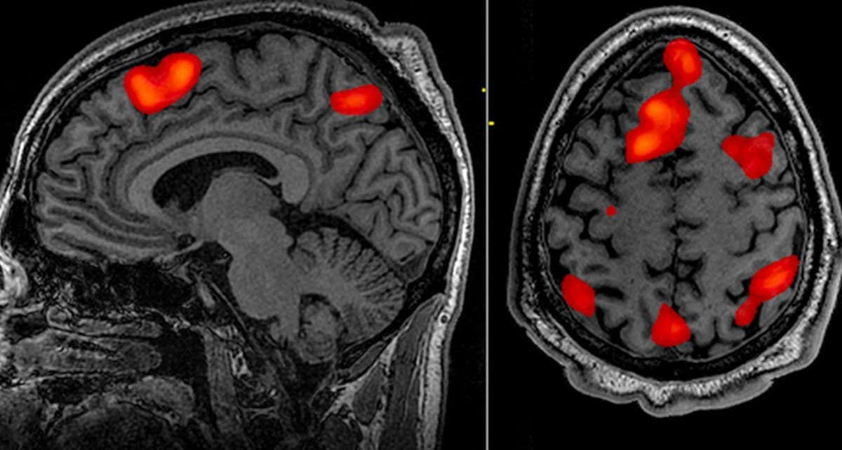 Brain scanning studies are usually too small to find reliable results