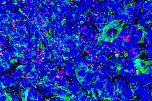 Pancreatic cancer immunotherapy based on tetanus shrinks tumours in mice