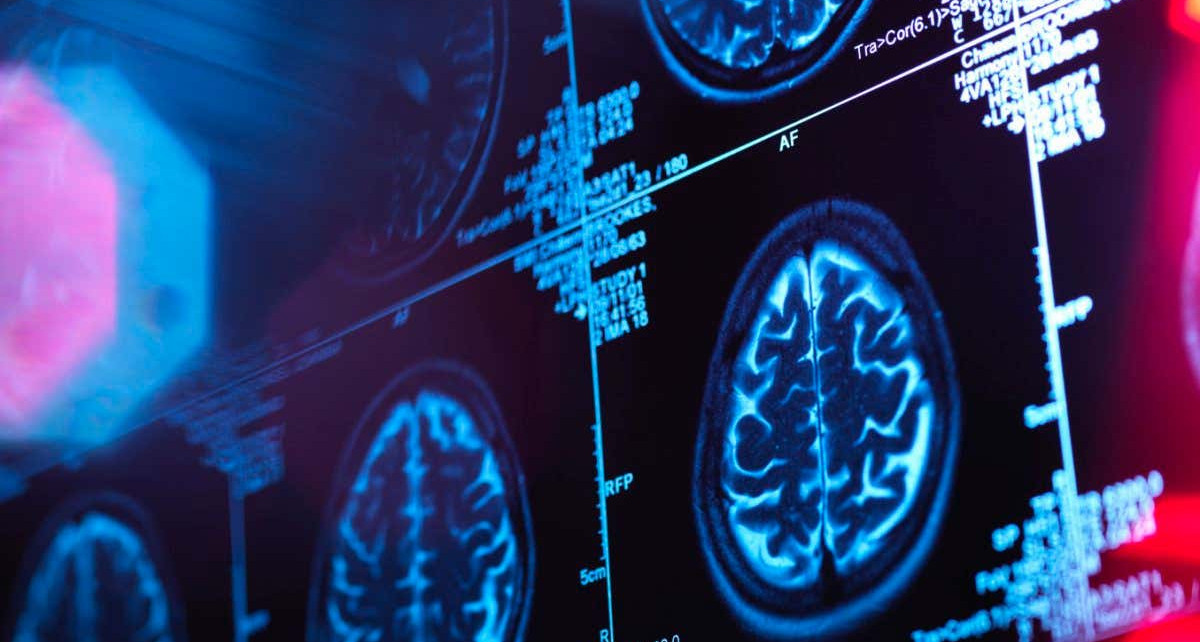 Alzheimer's drug lecanemab slows cognitive decline but concerns linger