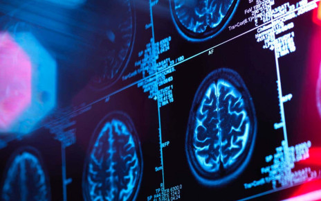 Alzheimer's drug lecanemab slows cognitive decline but concerns linger