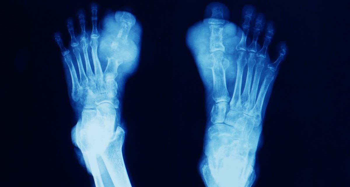 Gout linked to 376 genetic variants in a study of 2.6 million people