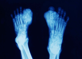 Gout linked to 376 genetic variants in a study of 2.6 million people