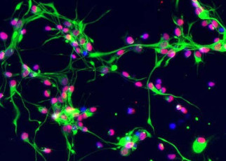 Fetal stem cell treatment for multiple sclerosis shows promising signs