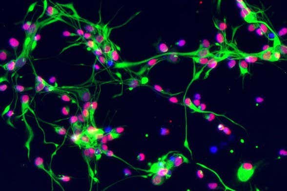 Fetal stem cell treatment for multiple sclerosis shows promising signs