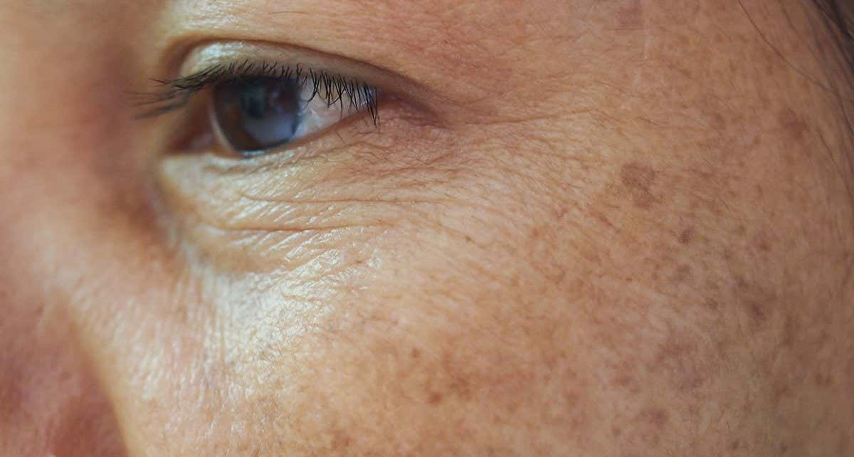 Anti-wrinkle patch uses microneedle injections to restore skin
