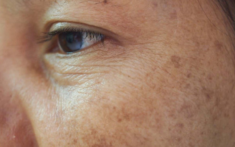 Anti-wrinkle patch uses microneedle injections to restore skin