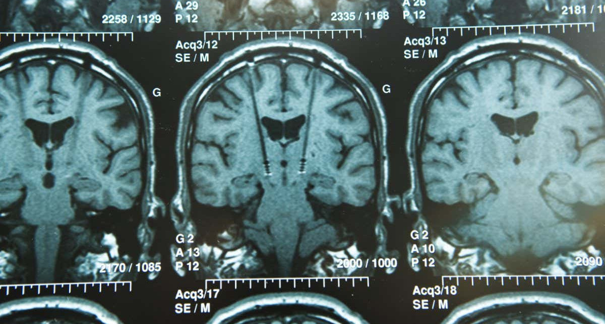 Deep brain stimulation could reduce emotional impact of memories