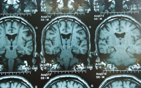 Deep brain stimulation could reduce emotional impact of memories