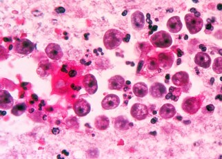 Man in Florida killed by rare, brain-eating amoeba Naegleria fowleri