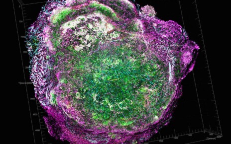AI speeds up design of new antibodies that could target breast cancer
