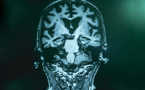 alzheimer's disease with MRI; Shutterstock ID 1025800153; purchase_order: -; job: -; client: -; other: -