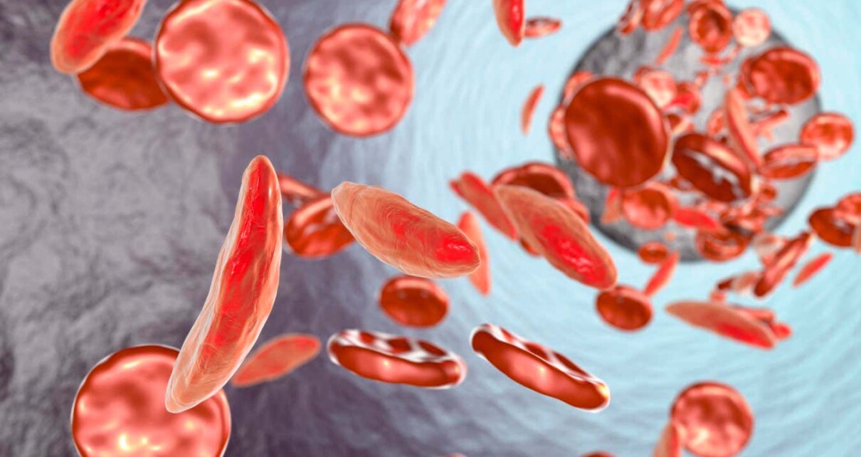 Sickle cell disease is now curable, but the treatment is unaffordable