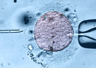 A light micrograph of a sperm cell being injected into an egg via an intracytoplasmic sperm injection (ICSI)