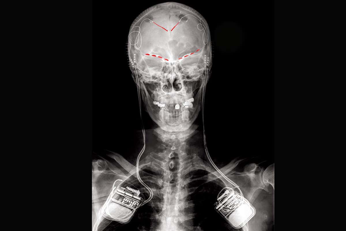 An X-ray of one study participant, showing implanted electrodes (red patches) connected to a recording implant on both sides of the brain