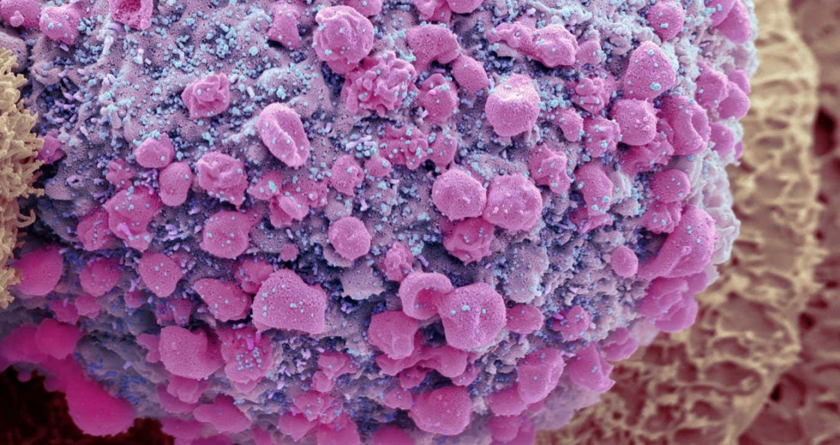 A scanning electron micrograph of the delta SARS-CoV-2 variant (pink dots) budding from a human gut cell