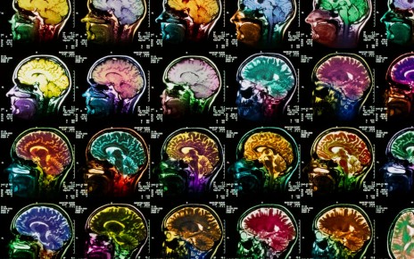 Magnetic resonance imaging scans showing healthy healthy brains