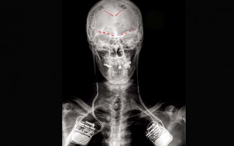An X-ray of one study participant, showing implanted electrodes (red patches) connected to a recording implant on both sides of the brain