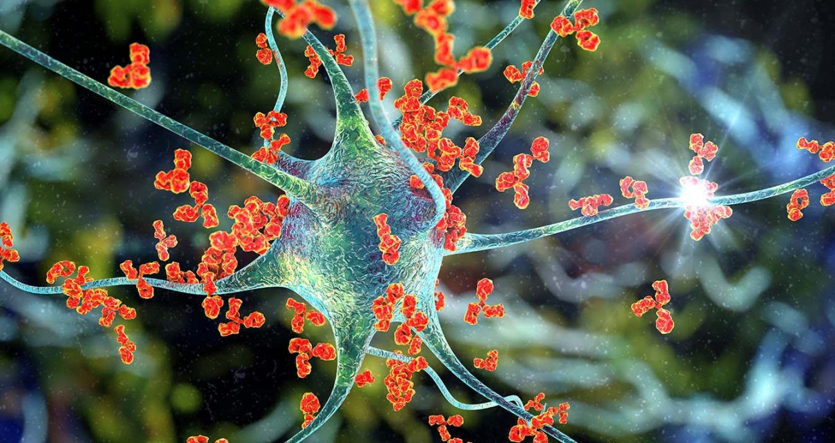 Many autoantibodies, shown as orange, triple lobed forms, surround and attack a much larger, pale, partially translucent nerve cell in a computer generated illustration