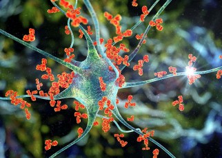 Many autoantibodies, shown as orange, triple lobed forms, surround and attack a much larger, pale, partially translucent nerve cell in a computer generated illustration