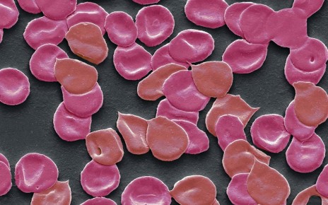 A scanning electron micrograph of blood from someone with iron deficiency anaemia, showing irregularly-shaped, small red blood cells