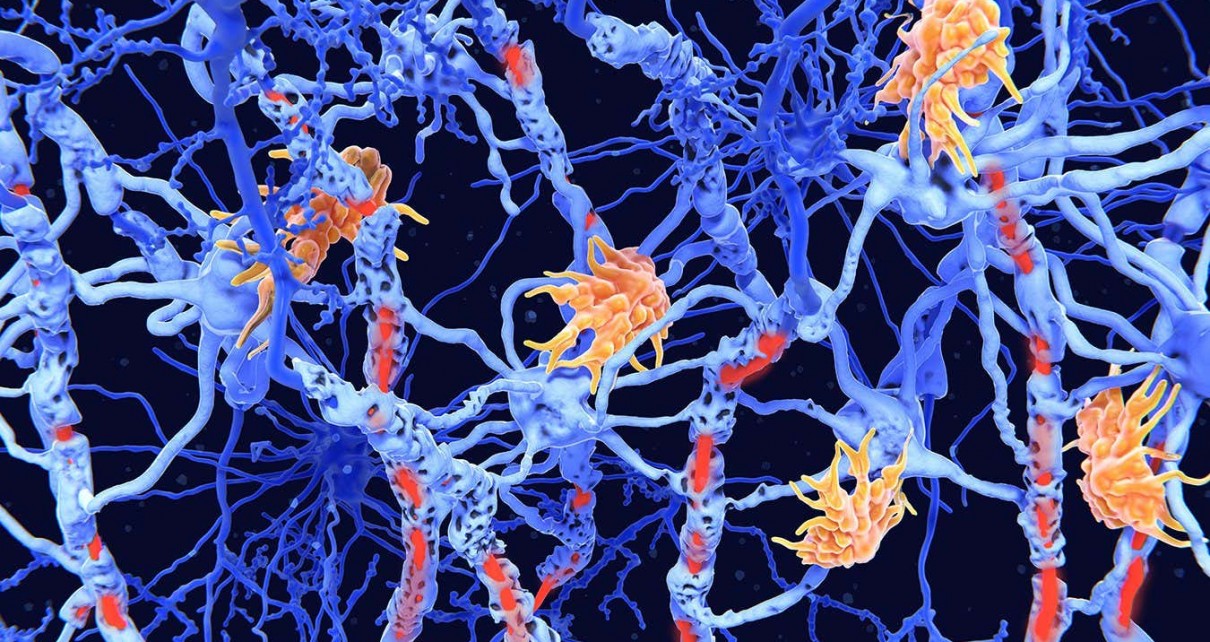 Multiple sclerosis: Genetic marker discovered for severity of the disease