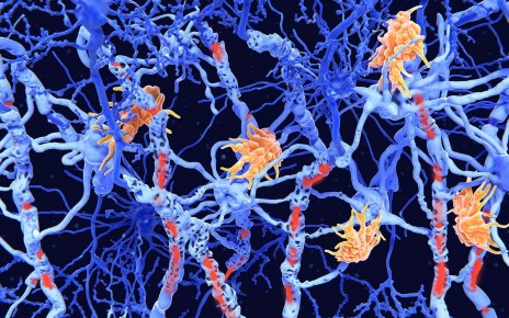 Multiple sclerosis: Genetic marker discovered for severity of the disease