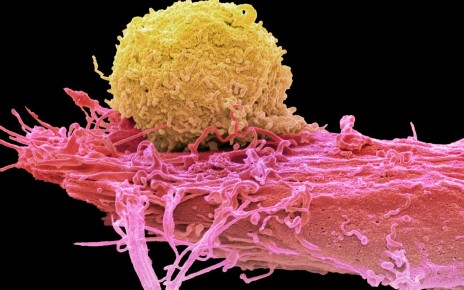 How cancer-fighting immune cells could be made safer and more powerful