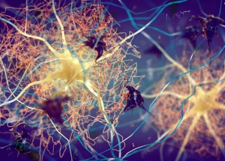 Amyloid plaques in the brain of someone with Alzheimer's disease. The condition has also been linked to too much cholesterol in brain cells, slowing brain signalling