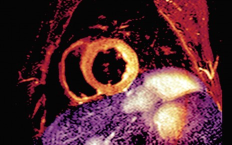 An MRI scan of a section through the chest and heart of someone who had a heart attack showing damage and swelling (yellow, centre)