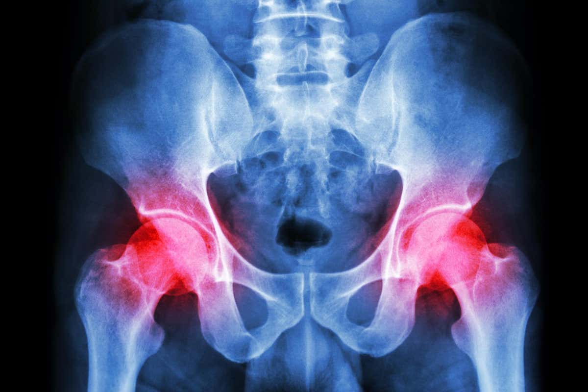 X-ray of a pelvis with arthritis, a key cause of hip pain, at both hip joints