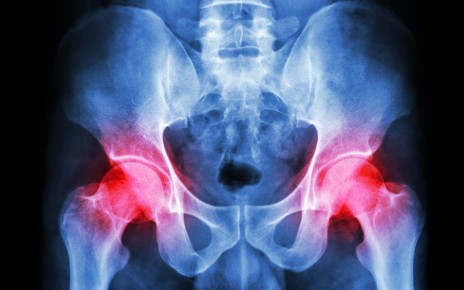 X-ray of a pelvis with arthritis, a key cause of hip pain, at both hip joints