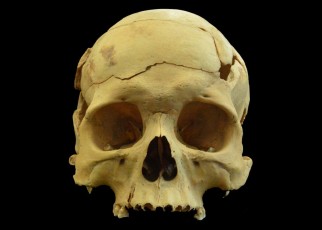 The skulls shows signs of healing within the walls of the fracture lines, inflicted by a blunt force injury