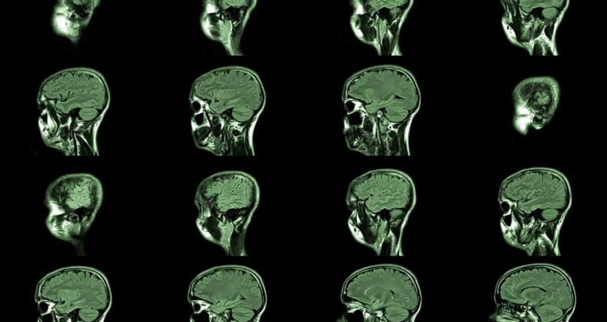 magnetic resonance imaging, MRI MRT head