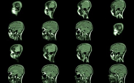 magnetic resonance imaging, MRI MRT head