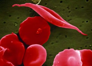 Sickle cell CRISPR 'cure' is the start of a revolution in medicine