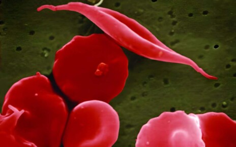 Sickle cell CRISPR 'cure' is the start of a revolution in medicine