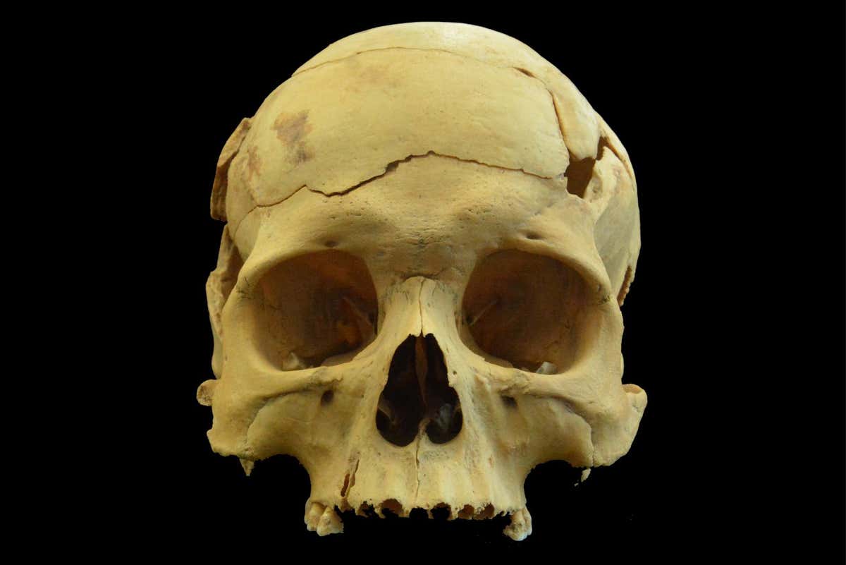 The skulls shows signs of healing within the walls of the fracture lines, inflicted by a blunt force injury