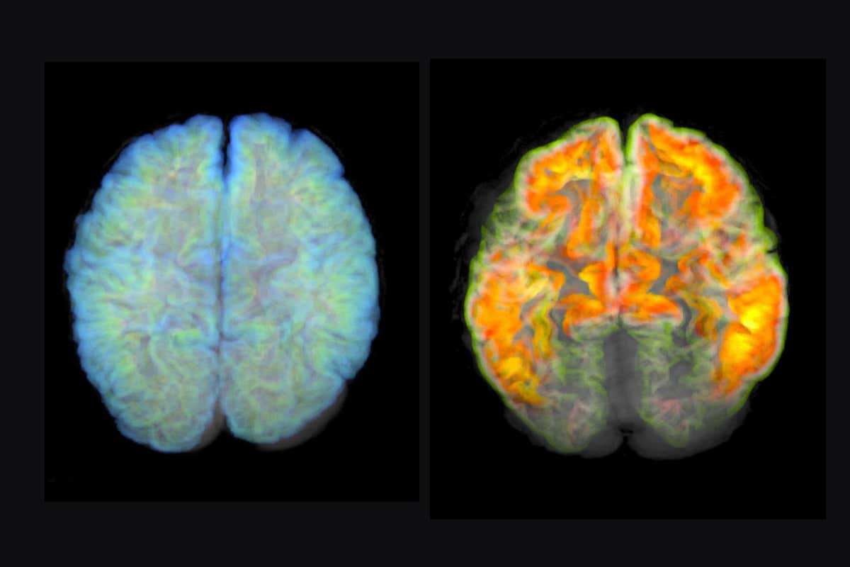 MRI scans of a healthy brain (left) and a brain with amyloid plaque deposits (right), a sign of Alzhiemer's disease
