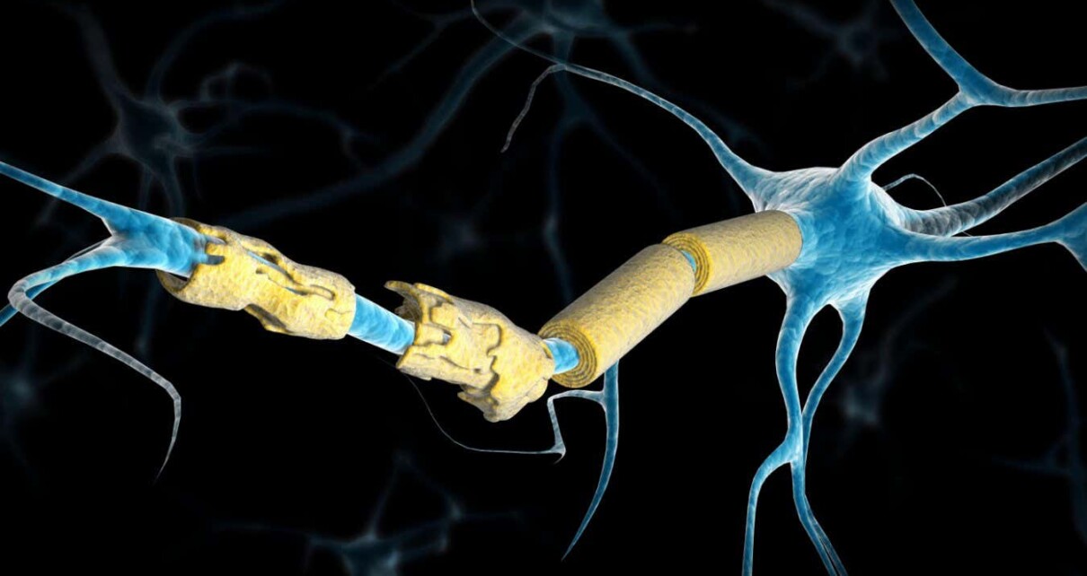 Conceptual image of a neuron damaged by multiple sclerosis