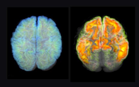 MRI scans of a healthy brain (left) and a brain with amyloid plaque deposits (right), a sign of Alzhiemer's disease