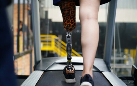 person with prosthetic limb