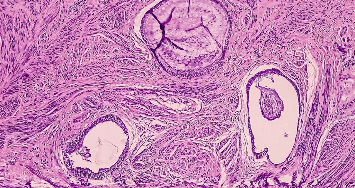 An endometriosis cyst in tissue from the uterus
