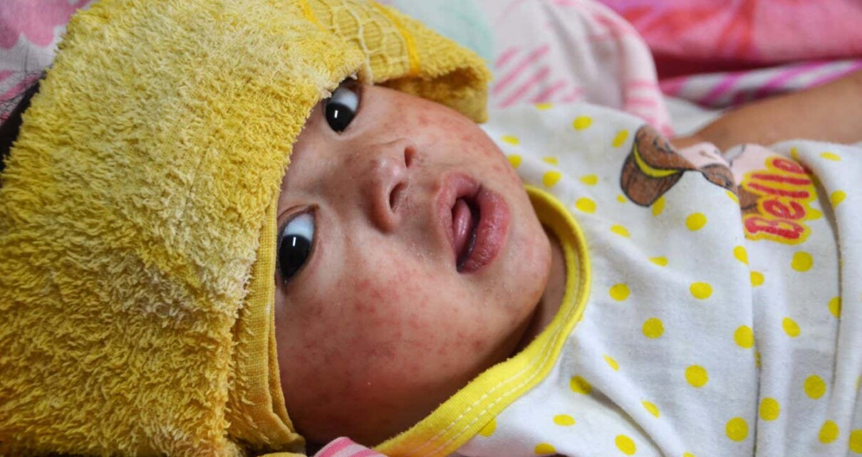 How measles can do long-lasting damage to children's immune systems